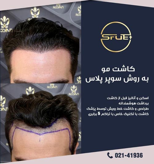 قبل و بعد از کاشت مو به روش SFUE