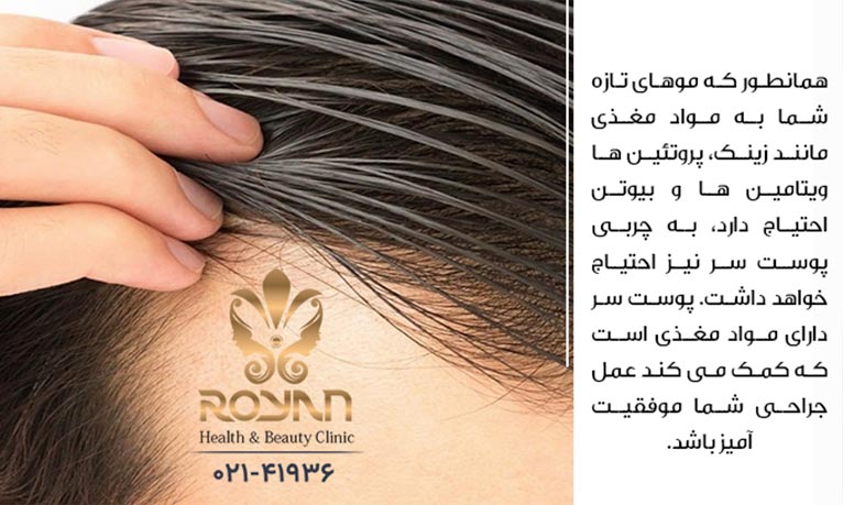 چرب شدن پوست سر بعد از کاشت موی طبیعی