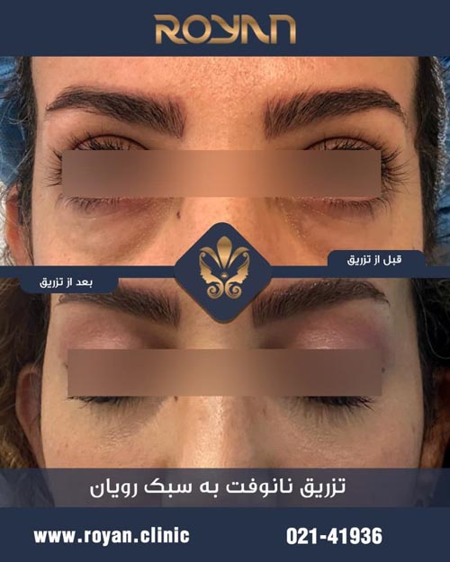 قبل و بعد از تزریق چربی زیر چشم