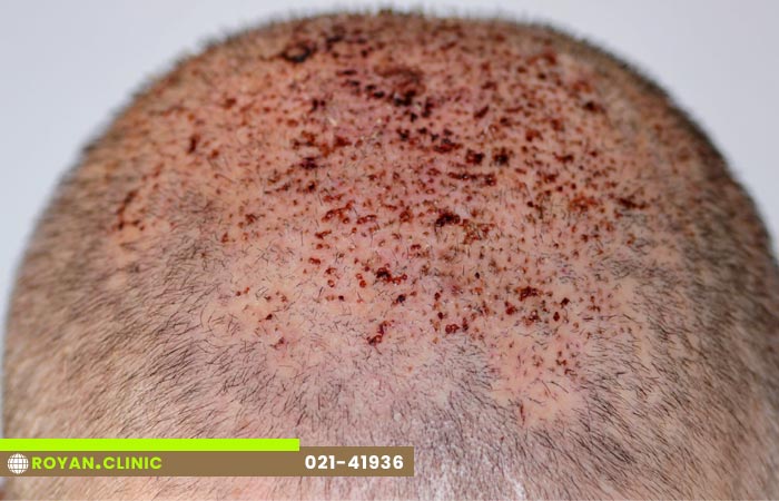 عفونت بعد از کاشت مو
