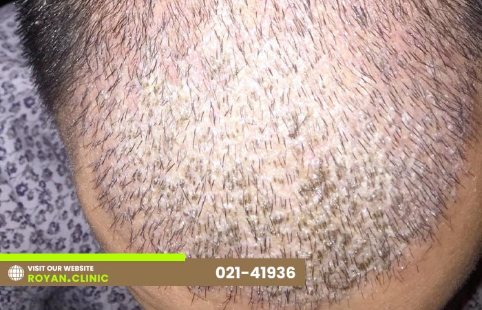 پوسته پوسته شدن سر بعد از کاشت مو